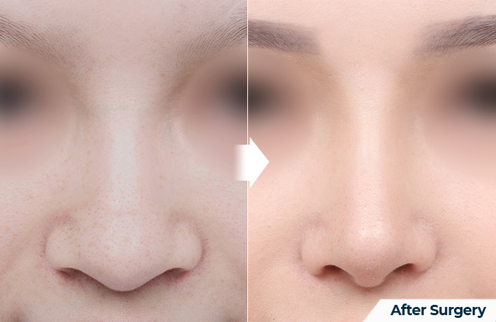 nose 92前后照片