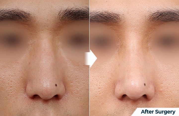 nose 93前后照片