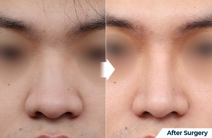 nose 94前后照片