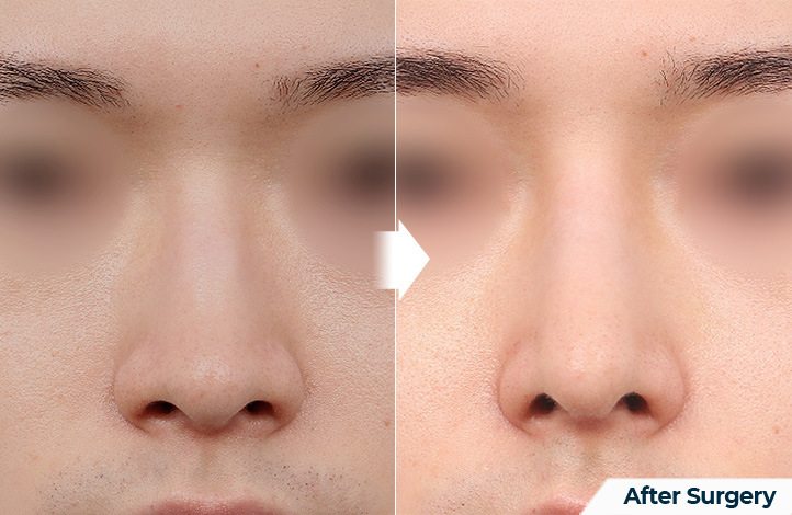 nose 95前后照片