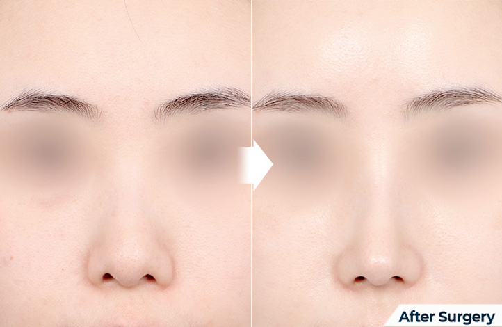 nose 99前后照片