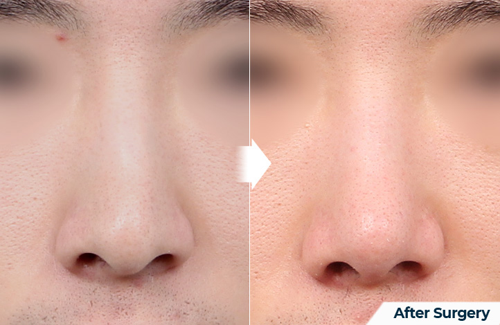 nose 100前后照片