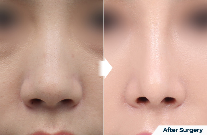 nose 101前后照片