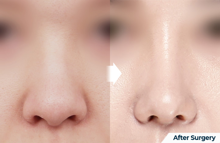 nose 102前后照片