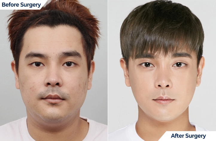 nose 103前后照片