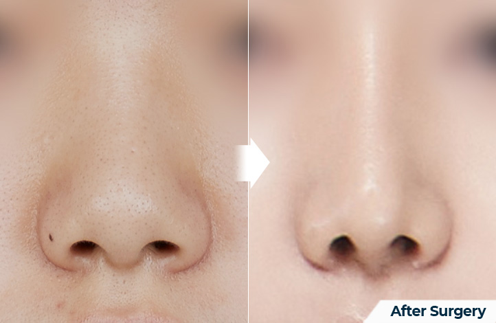 nose 104前后照片