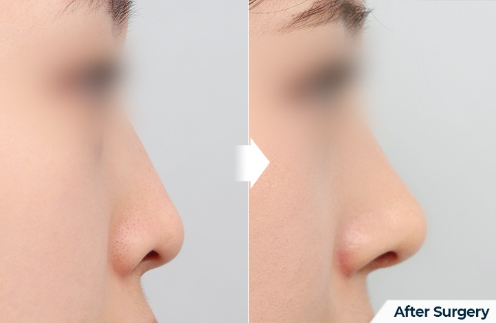 nose 105前后照片