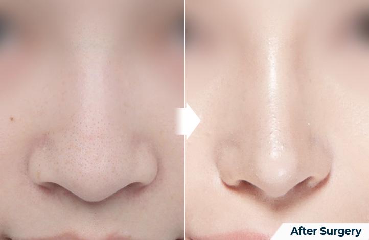nose 106前后照片