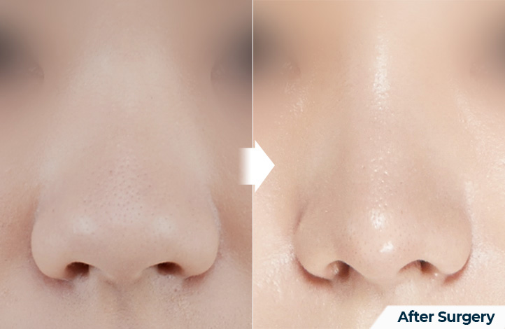 nose 107前后照片