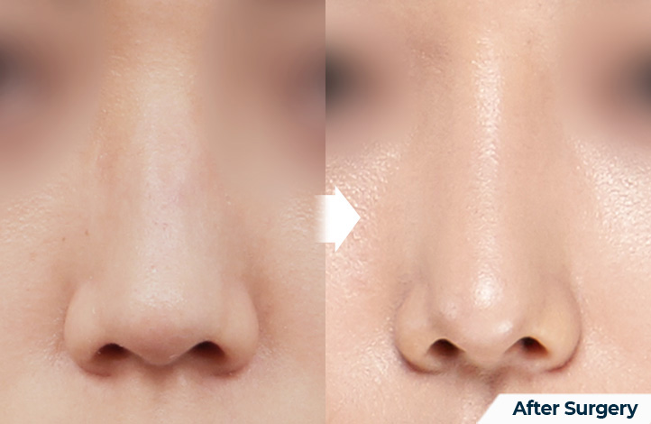 nose 108前后照片