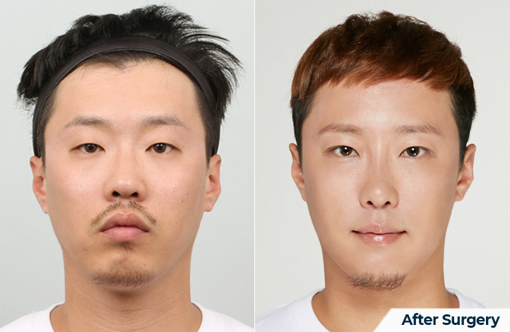 nose 111前后照片