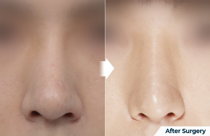 nose 112前后照片