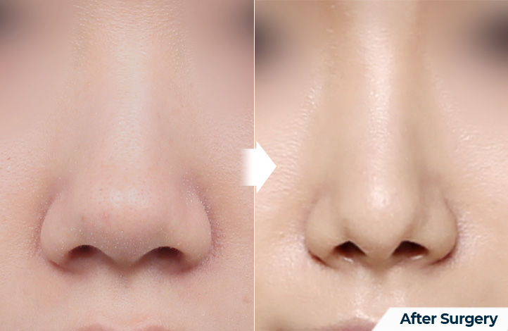 nose 113前后照片