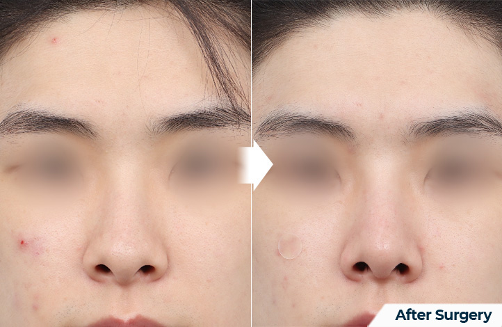 nose 114前后照片