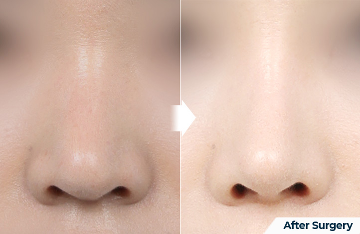 nose 115前后照片