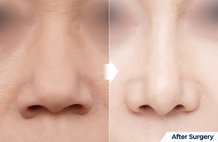 nose 116前后照片