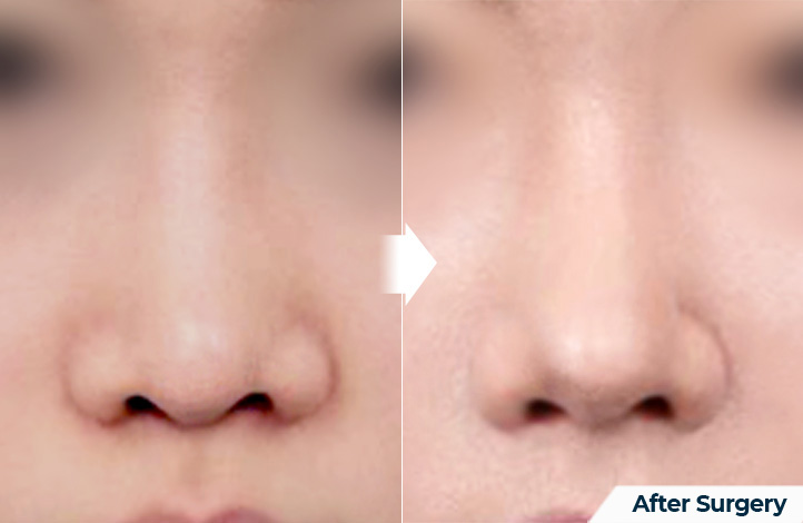 nose 117前后照片