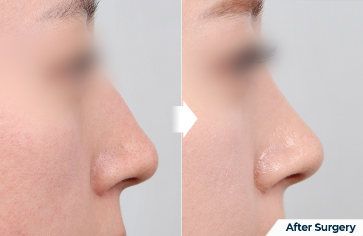 nose 118前后照片