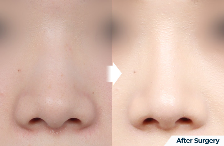 nose 119前后照片