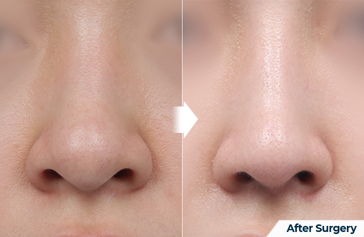nose 121前后照片