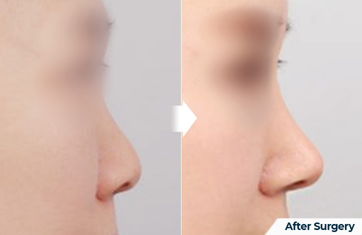 nose 122前后照片