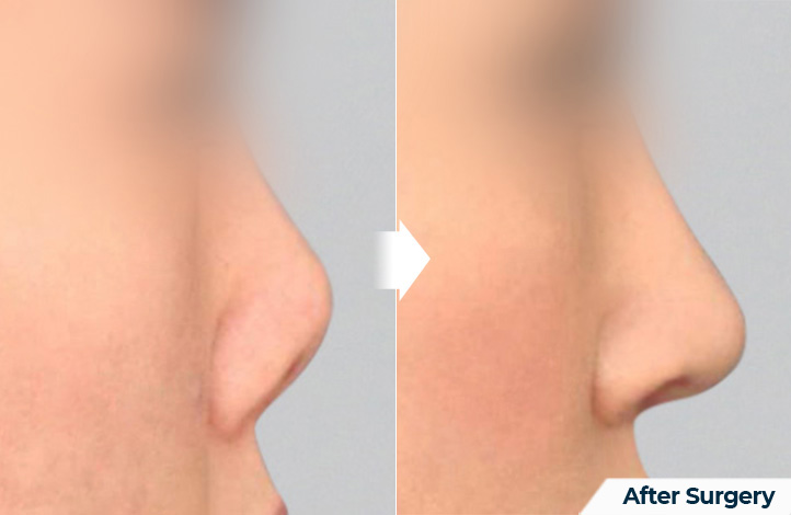 nose 123前后照片