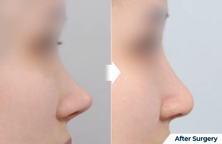 nose 124前后照片