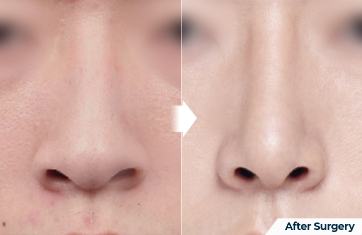 nose 125前后照片