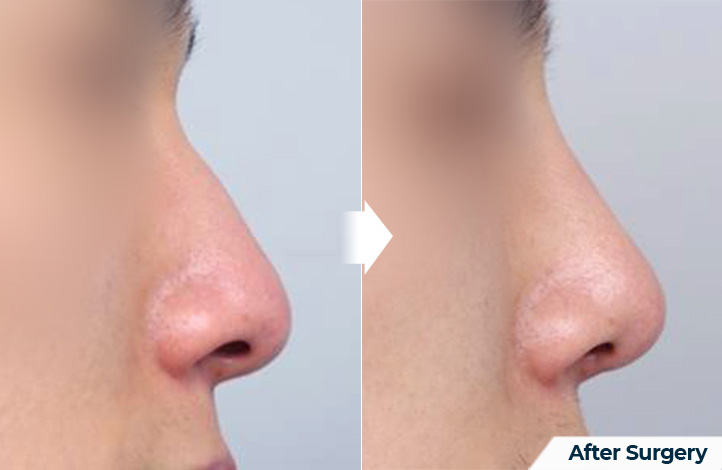 nose 126前后照片