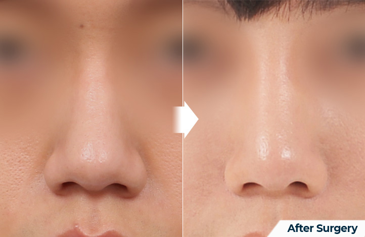 nose 127前后照片