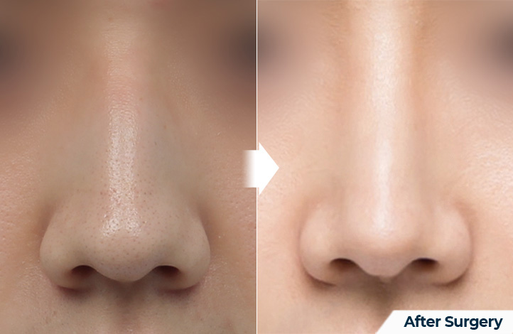 nose 128前后照片