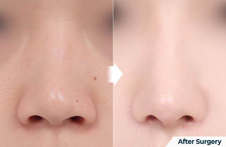 nose 129前后照片