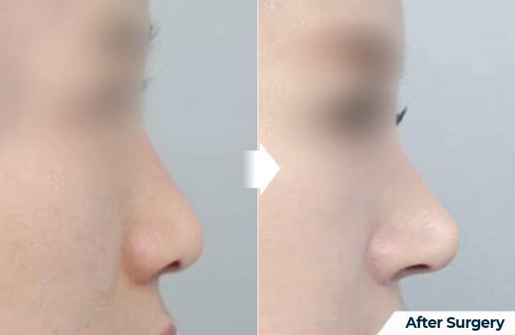 nose 130前后照片