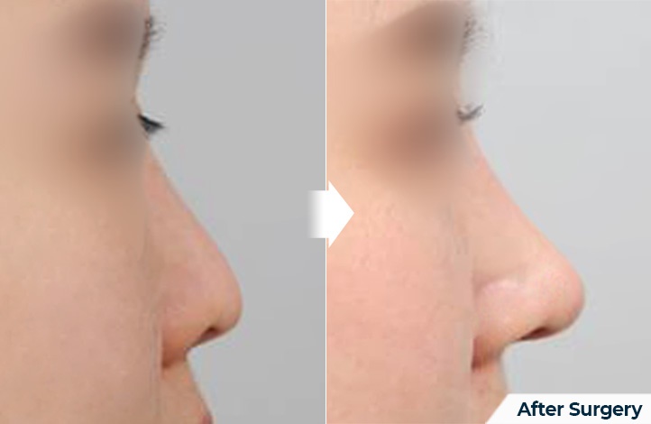 nose 132前后照片