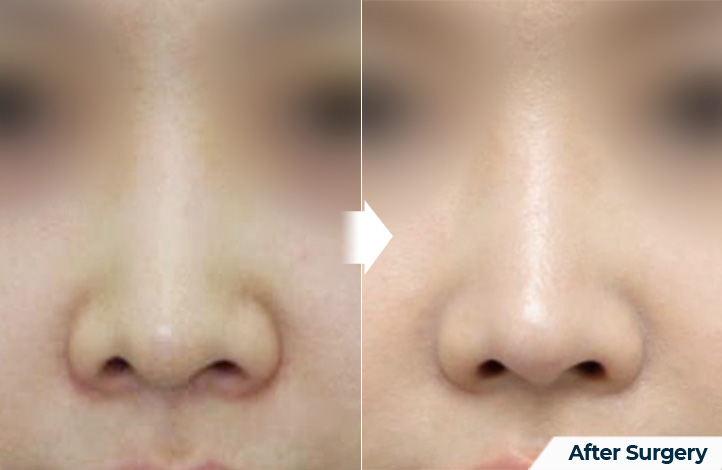 nose 134前后照片