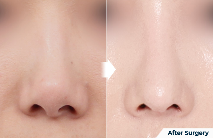nose 137前后照片