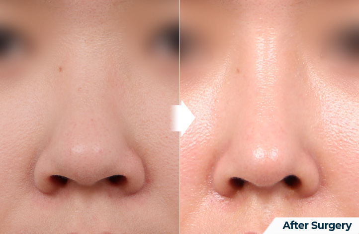 nose 136前后照片