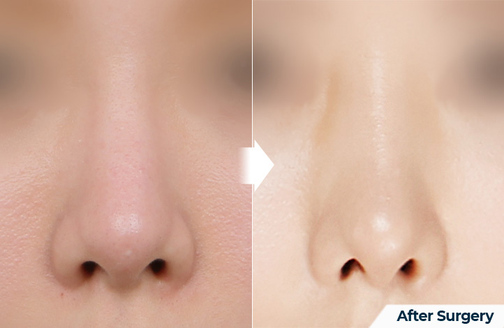 nose 138前后照片