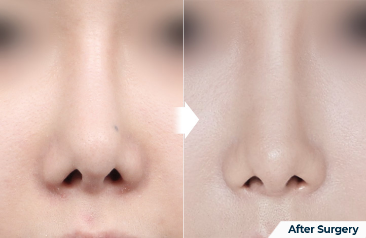 nose 139前后照片