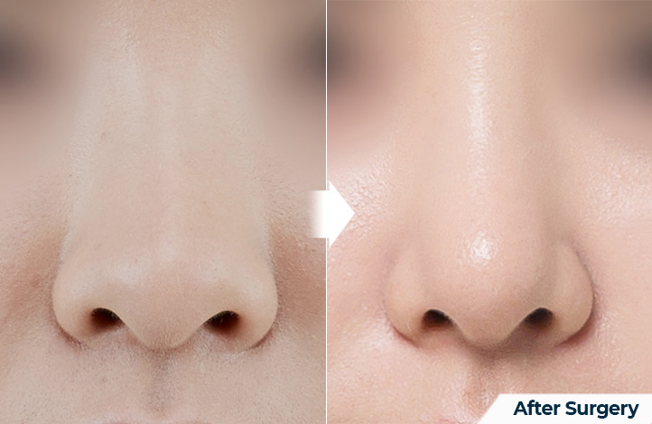 nose 140前后照片