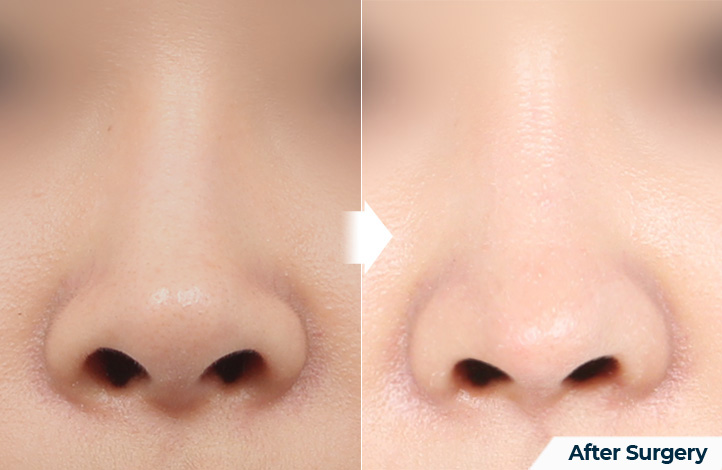 nose 141前后照片