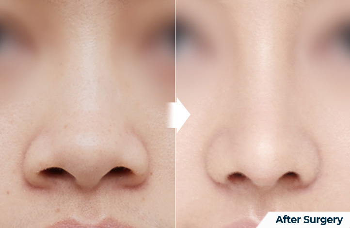 nose 142前后照片