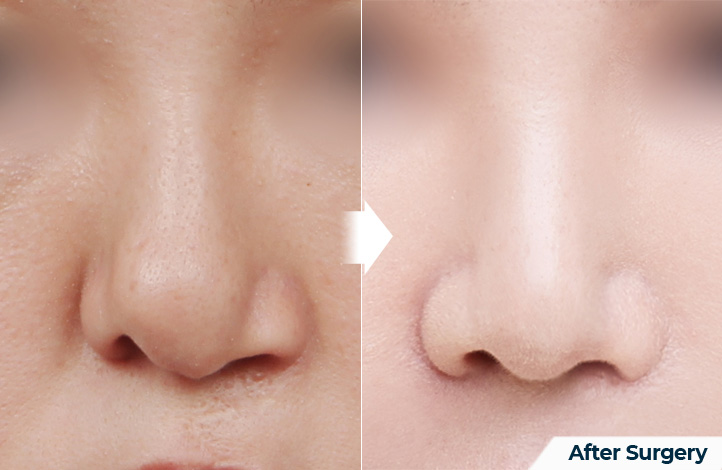 nose 144前后照片