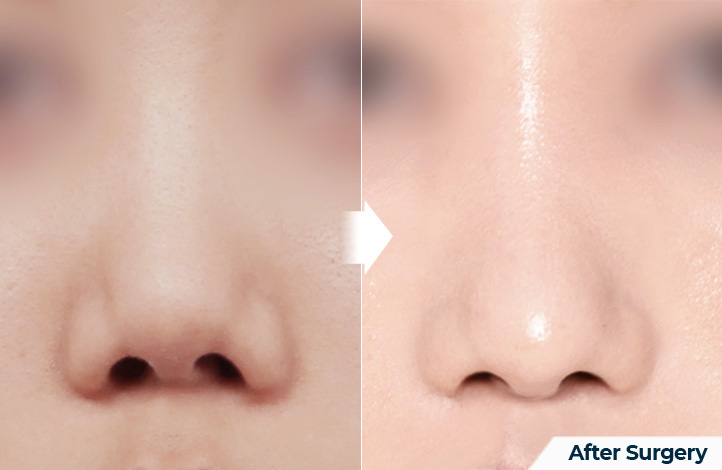 nose 145前后照片