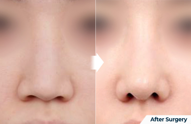 nose 146前后照片