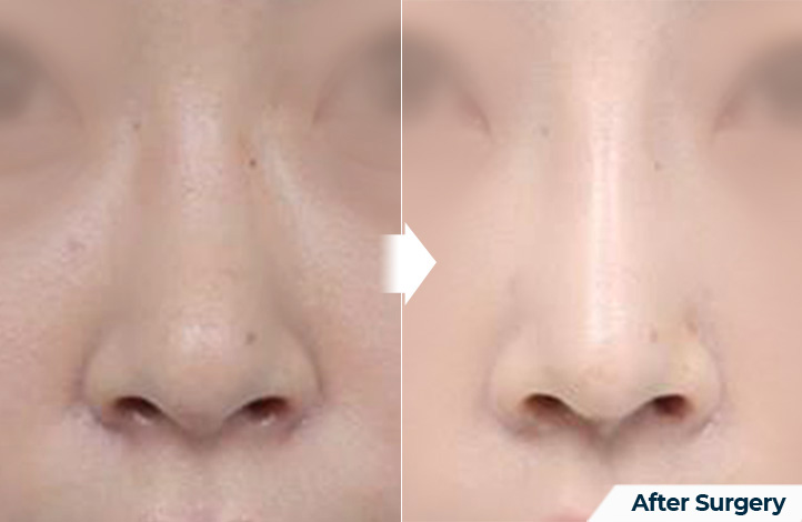 nose 147前后照片