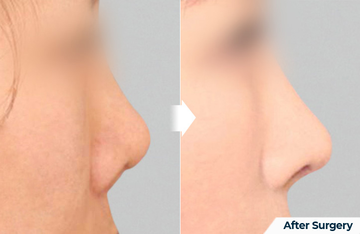 nose 149前后照片