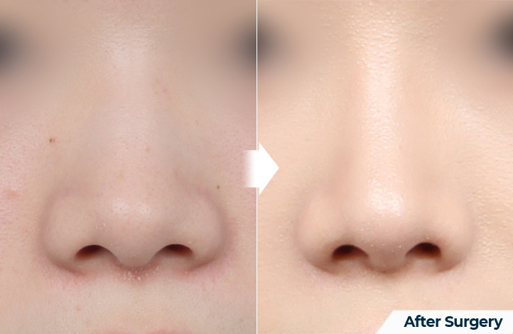 nose 150前后照片