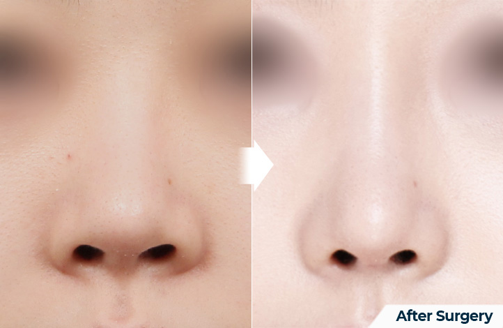 nose 148前后照片