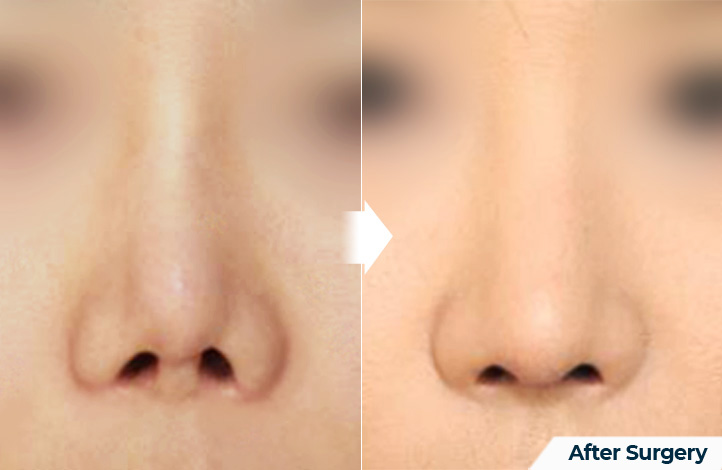 nose 151前后照片